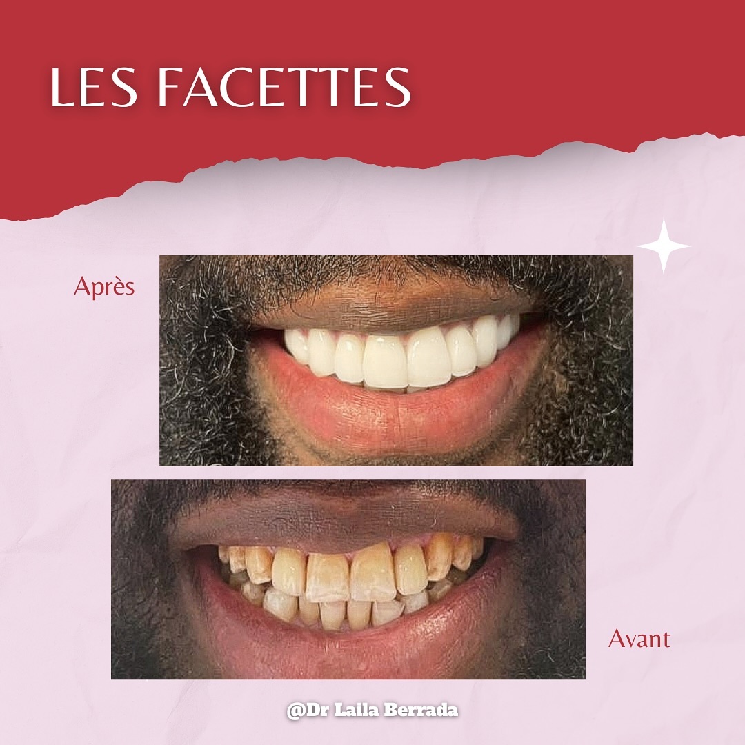Transformation de sourire - Cas 2